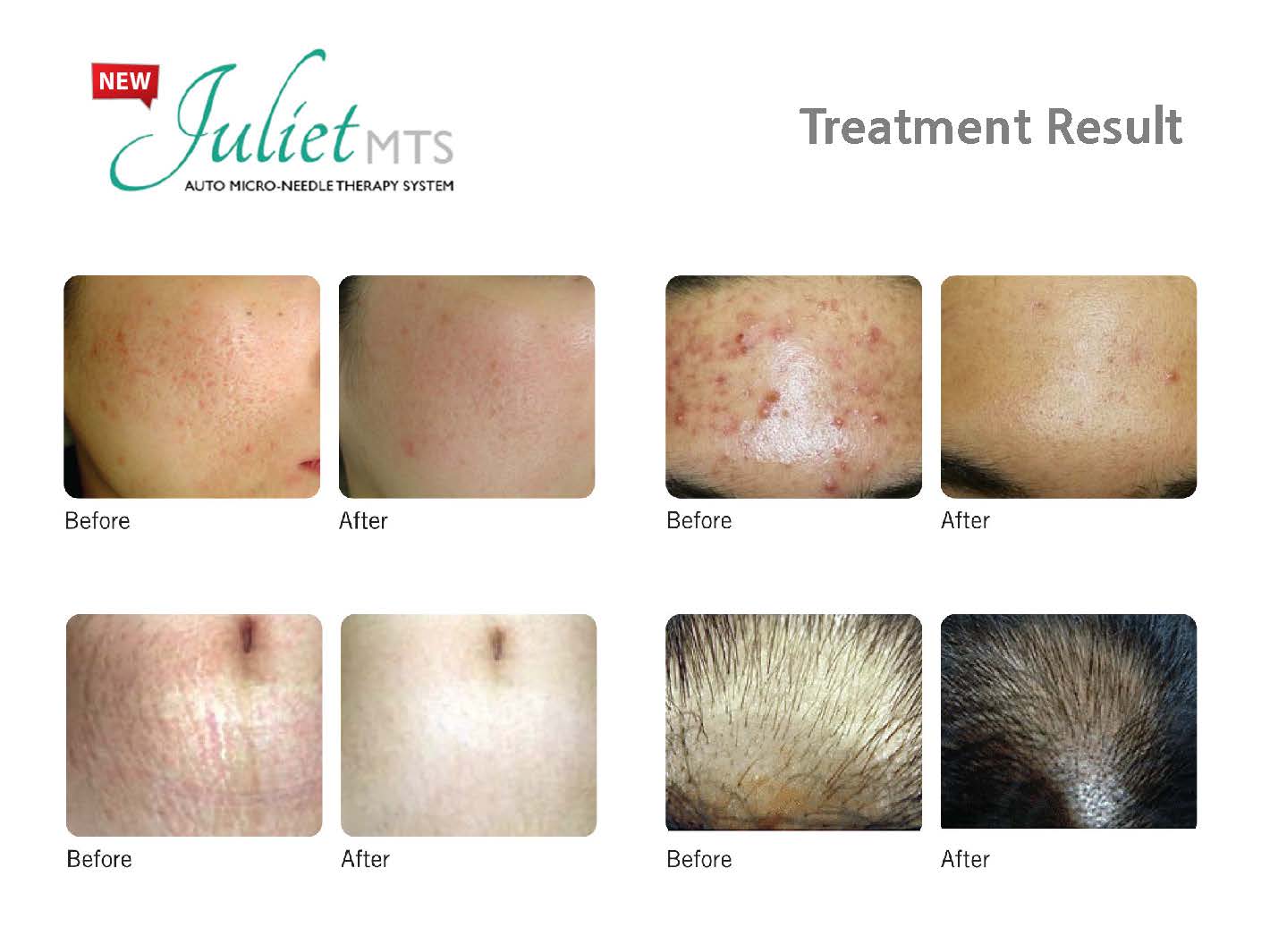 Needle Skin Treatment — Needle Therapy Results in Cerritos, CA
