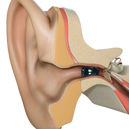in ear canal hearing aid