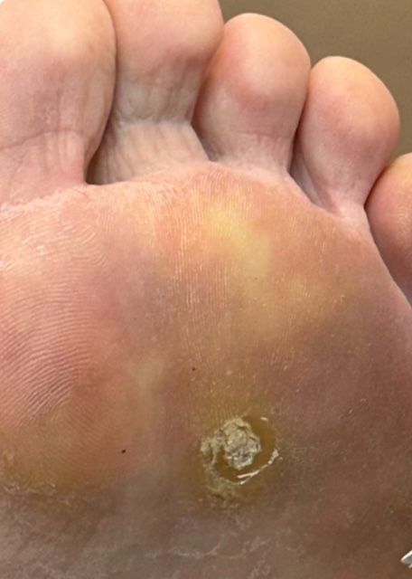 A close up of a foot with a wart on it.
