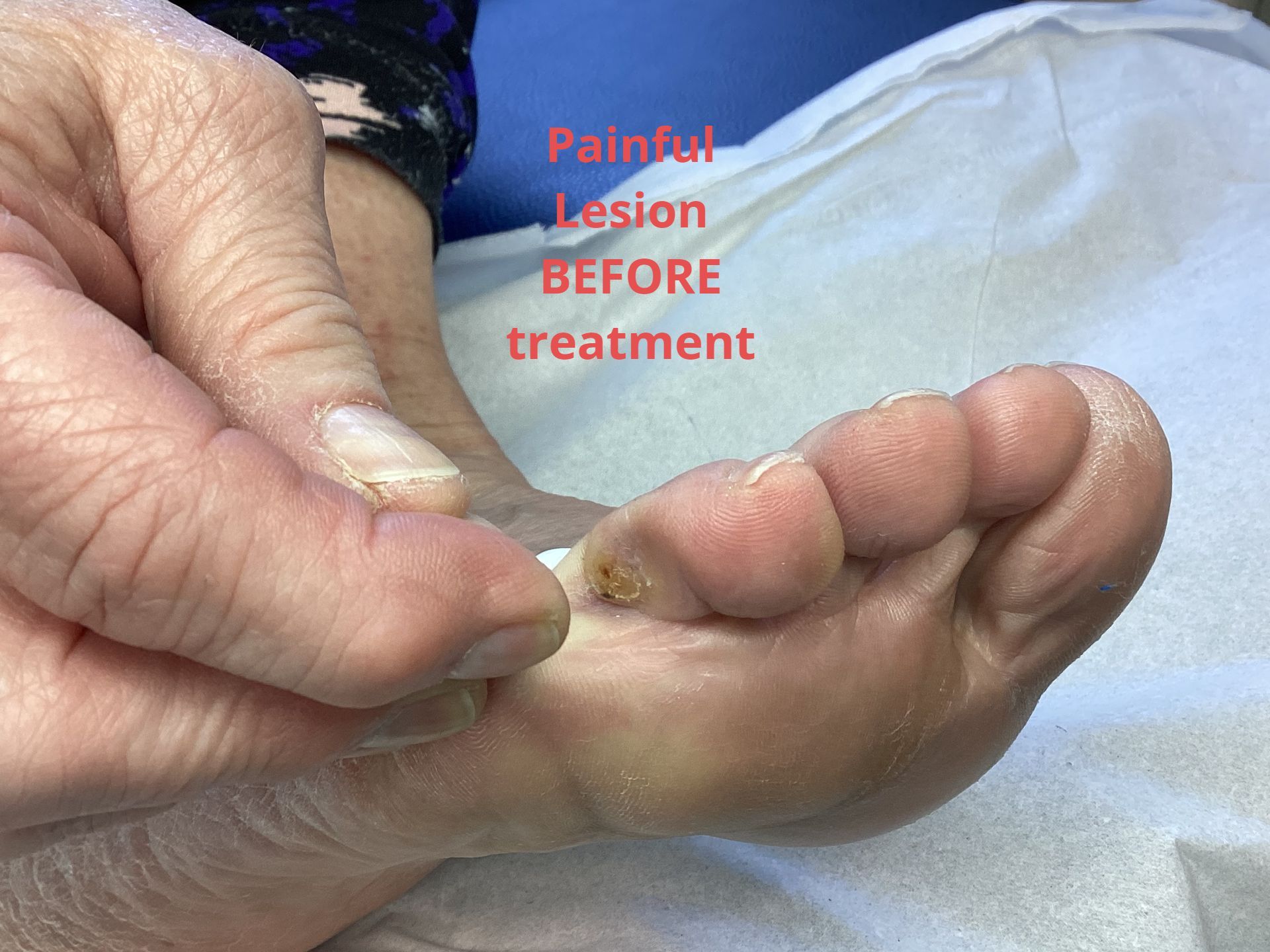 Use of Hyaluronic acid to treat painful corns at York Podiatry Ltd 