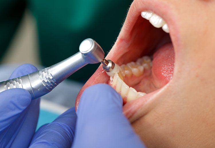 Dental Teeth Cleaning — Liberty, MO — Triplett Dental