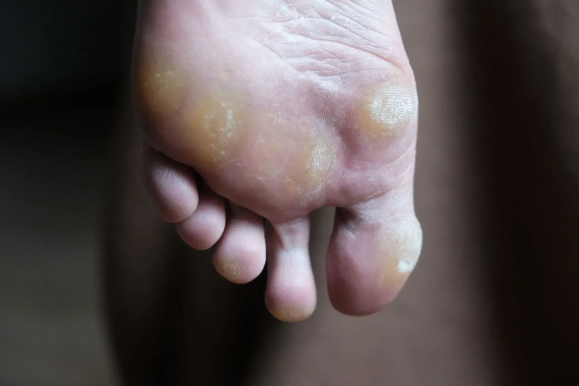 A human foot showing several thickened, calloused patches of skin on the sole and base of the toes.