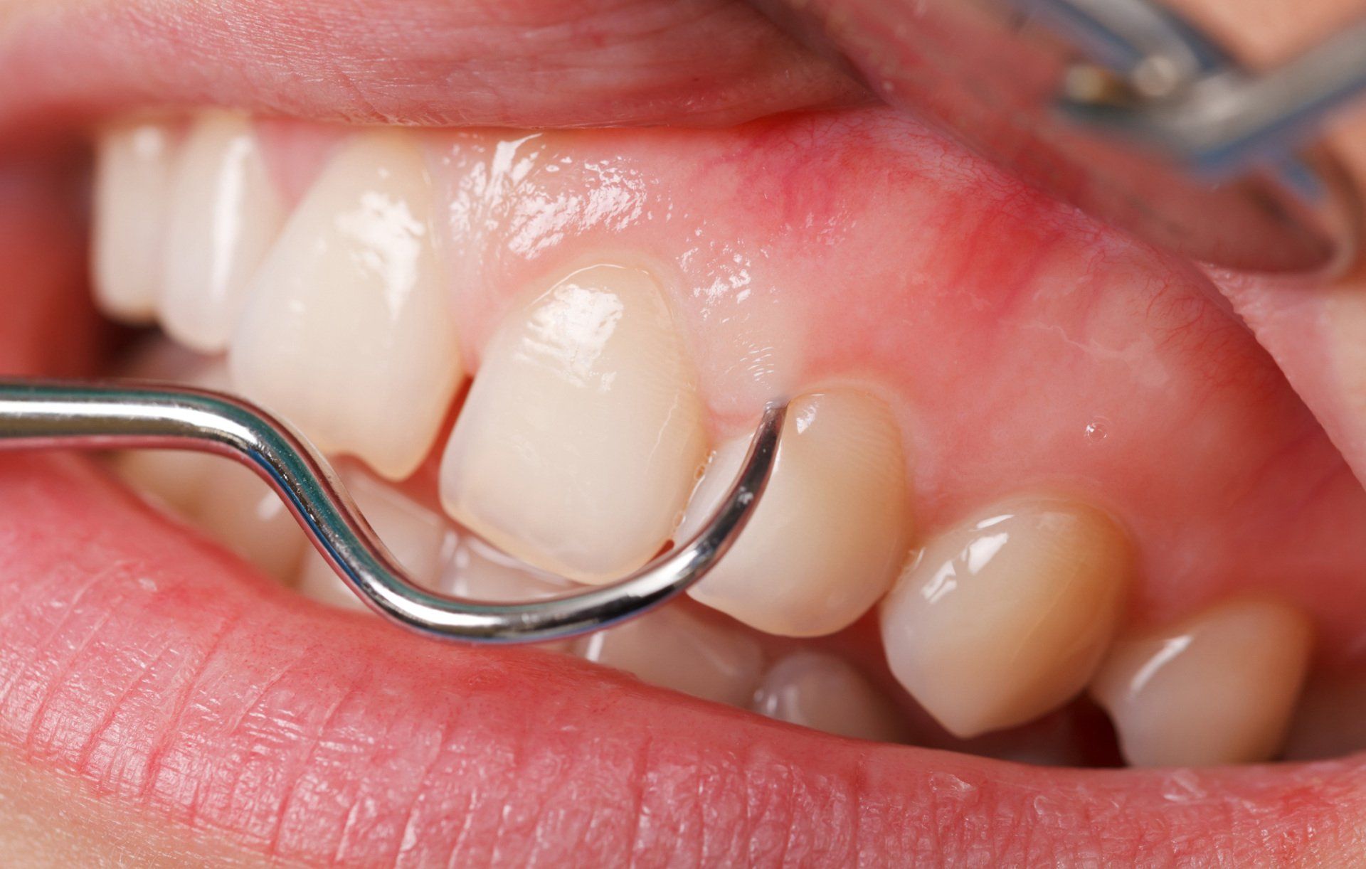 White Teeth — Pittsburgh, PA — Pittsburgh Dental Spa