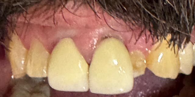 Close-up of yellowed upper front teeth and gums beneath dark hair.
