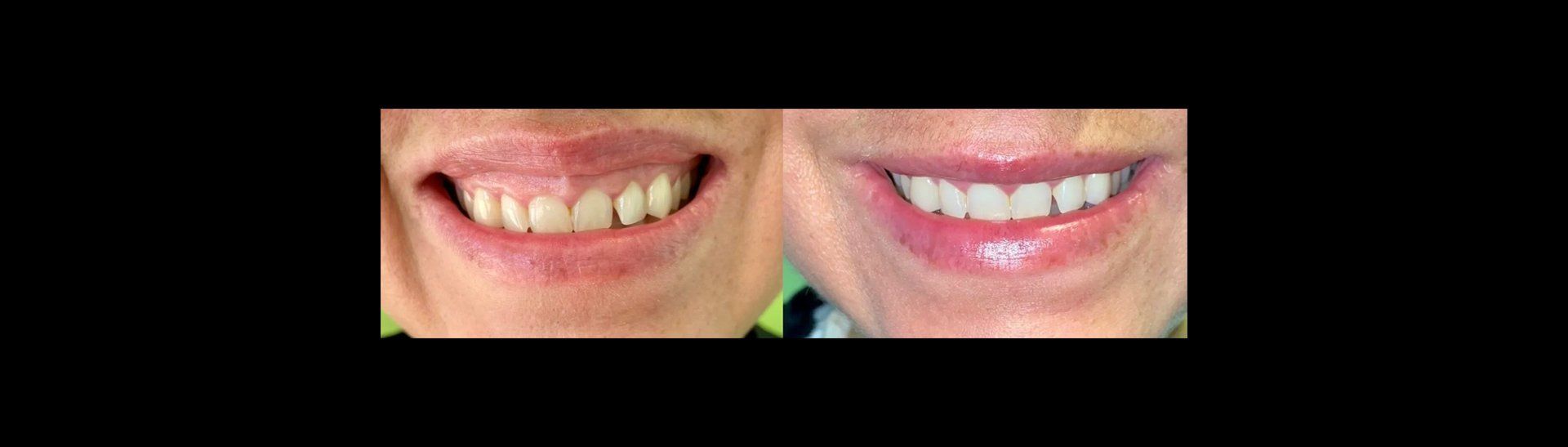 Comparison of a smile before and after dental work, showcasing teeth whitening and straightening.