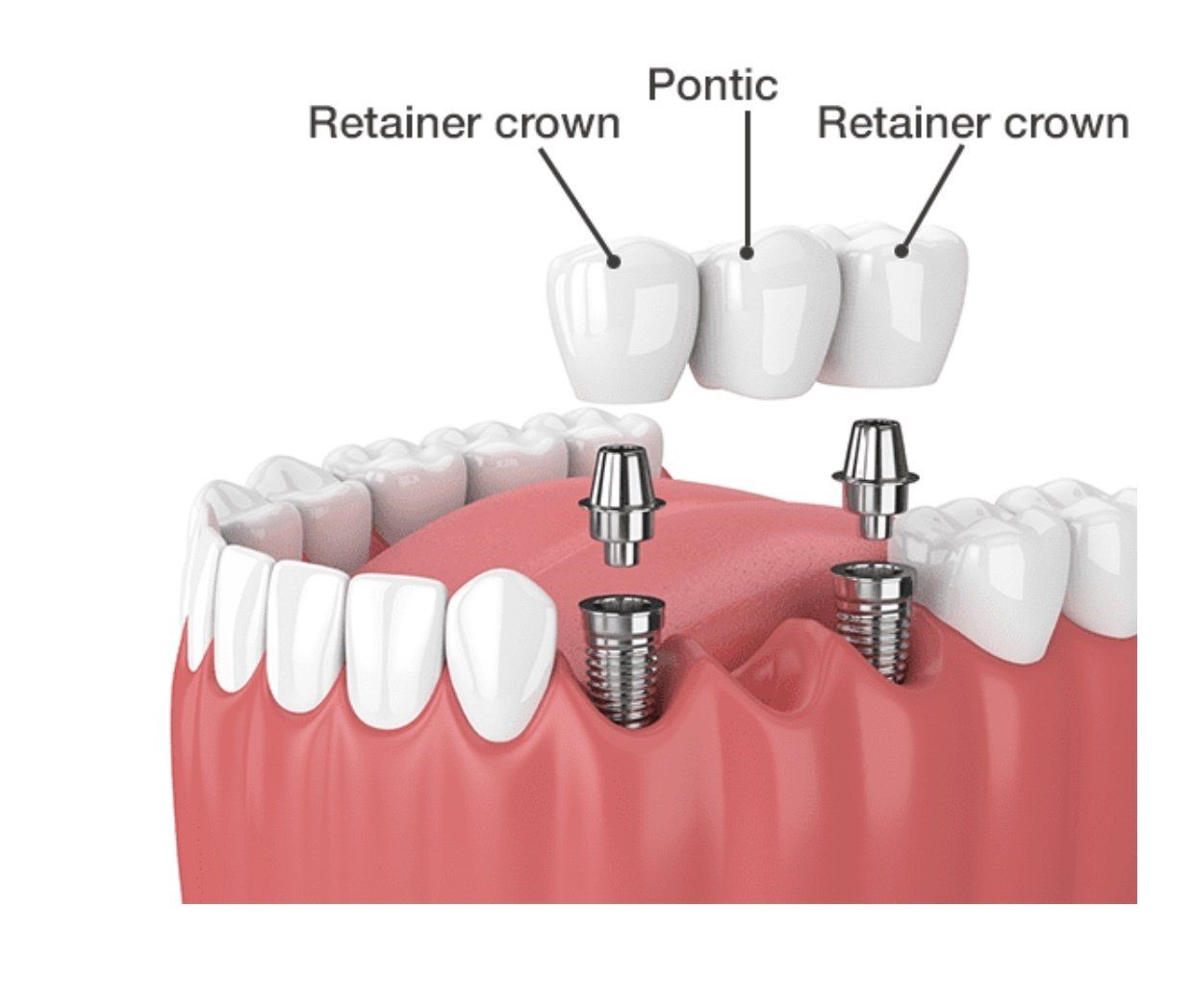 Multiple Teeth Dental Implant — Pittsburgh, PA — Pittsburgh Dental Spa