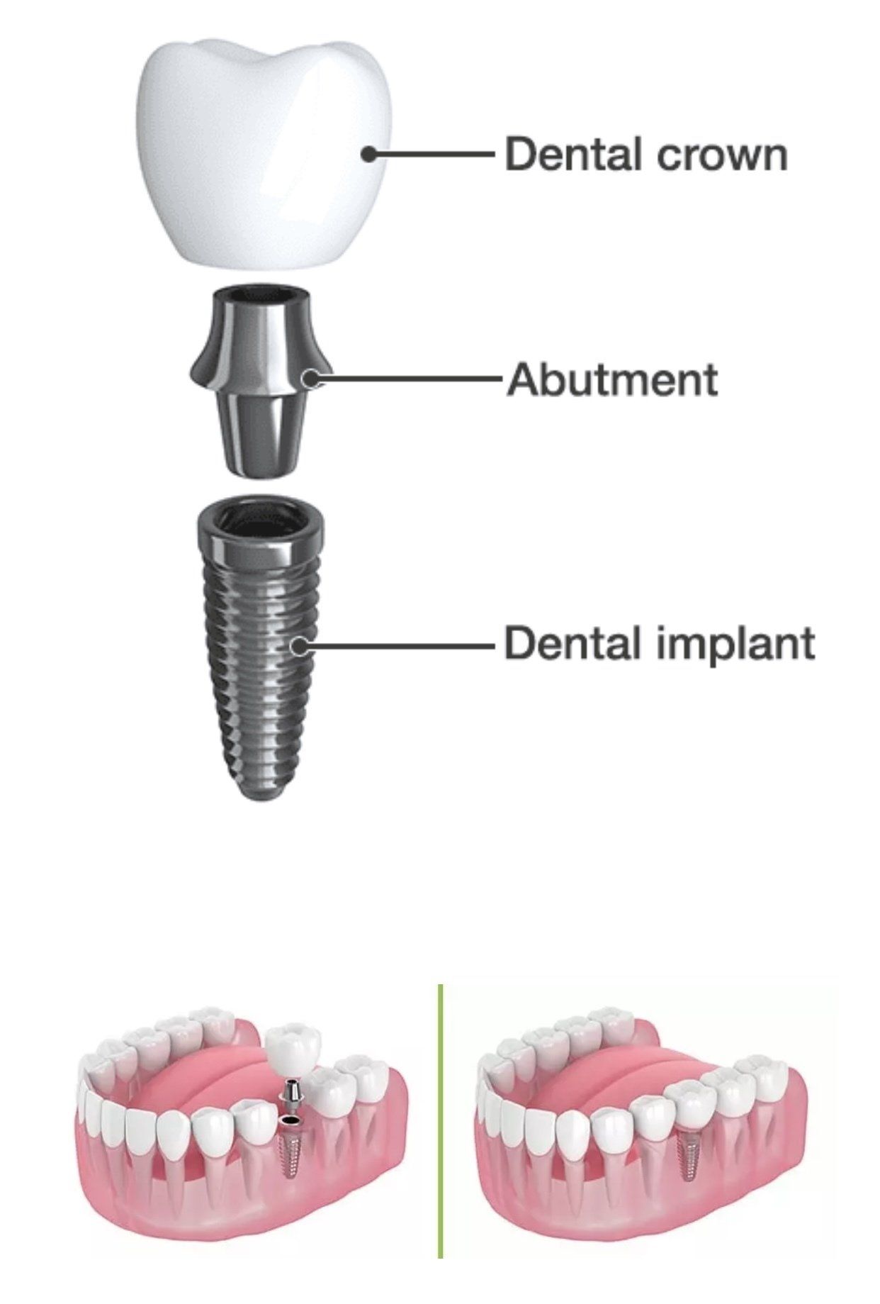 One Tooth Dental Implant — Pittsburgh, PA — Pittsburgh Dental Spa