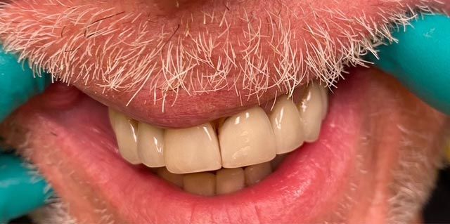 Close-up of a smiling mouth with teeth and white facial hair against a teal background