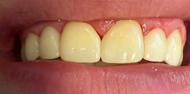 Close-up of upper front teeth with yellow discoloration, uneven alignment, and visible gum tissue