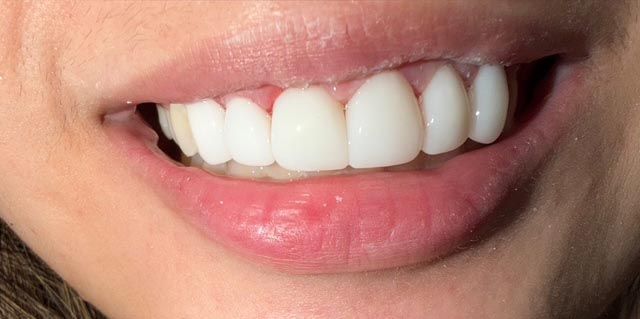 Close-up of a smiling mouth with white teeth and pink lips