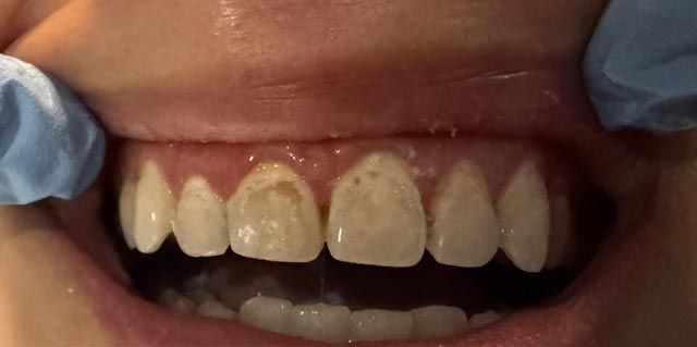 Close-up of teeth with upper front teeth stained yellow-brown and visible gums