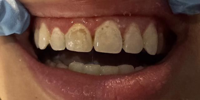 Close-up of a smiling mouth with teeth, some front teeth slightly discolored.