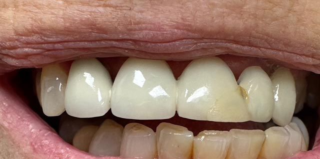 Close-up of a person's mouth showing slightly misaligned upper and lower teeth.