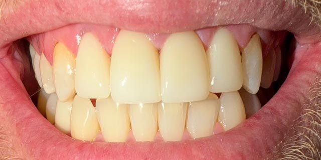 Close-up of a smiling mouth showing bright white teeth with slight gum redness
