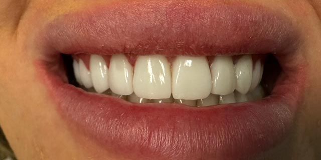 Close-up of smiling lips showing white teeth with a small gap between the front teeth