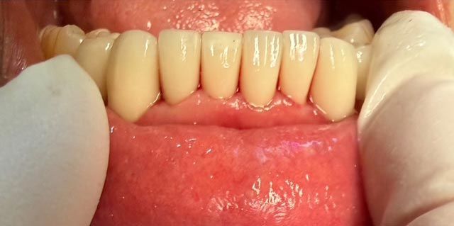 Close-up of upper and lower teeth with visible gum recession and a finger pointing at the front teeth