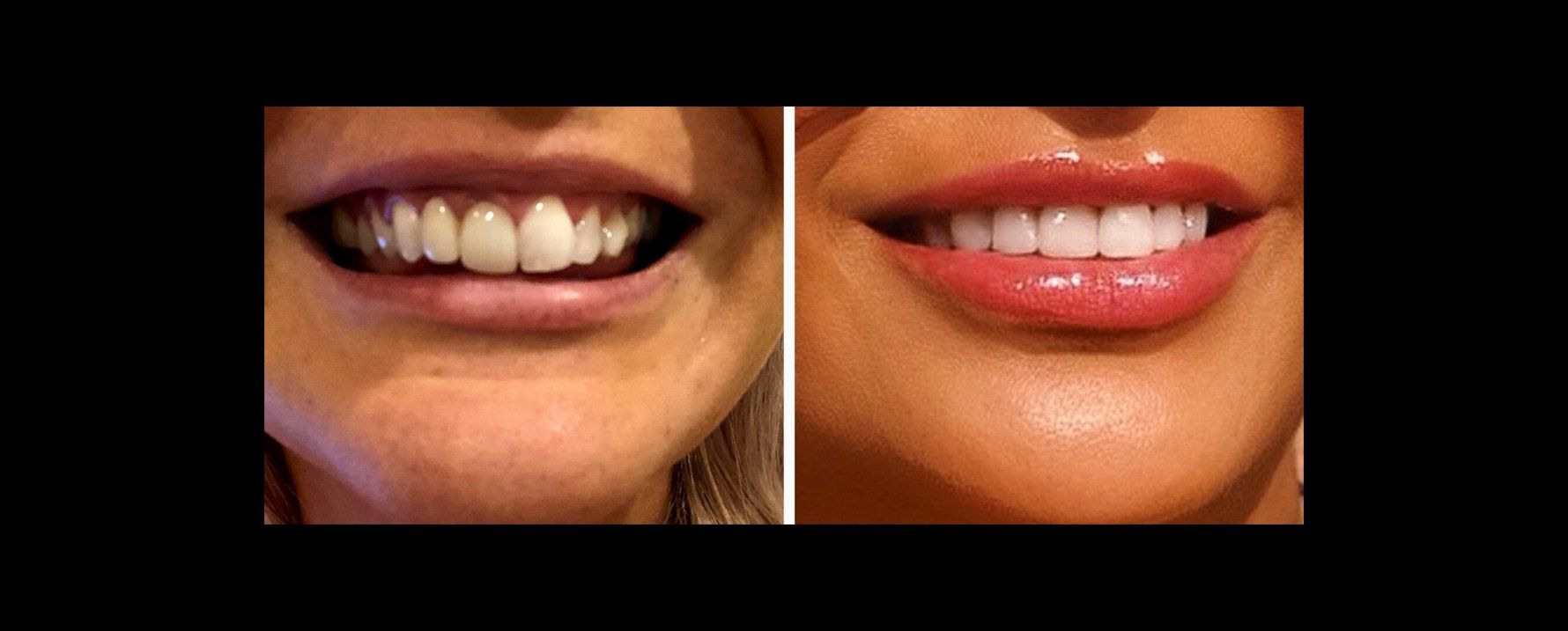 Before and after close-up of a smile; old teeth versus bright, white teeth.