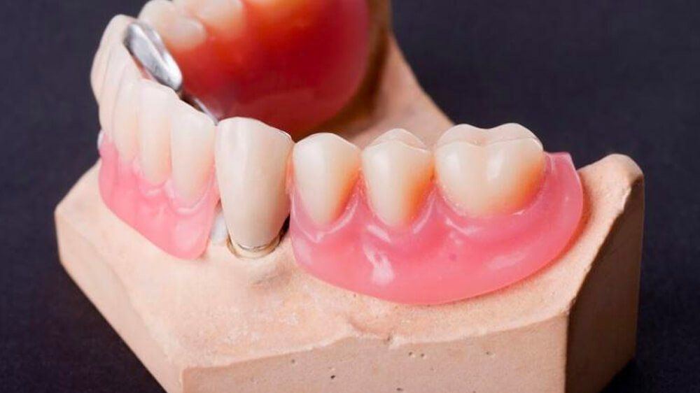 Missing Teeth Demo — Pittsburgh, PA — Pittsburgh Dental Spa