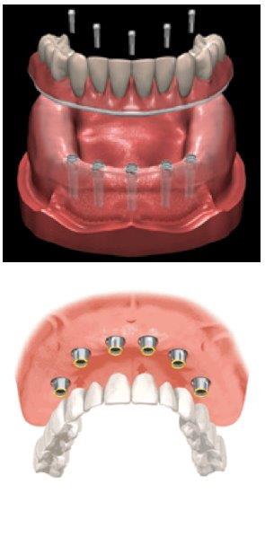 Dental Implants — Pittsburgh, PA — Pittsburgh Dental Spa
