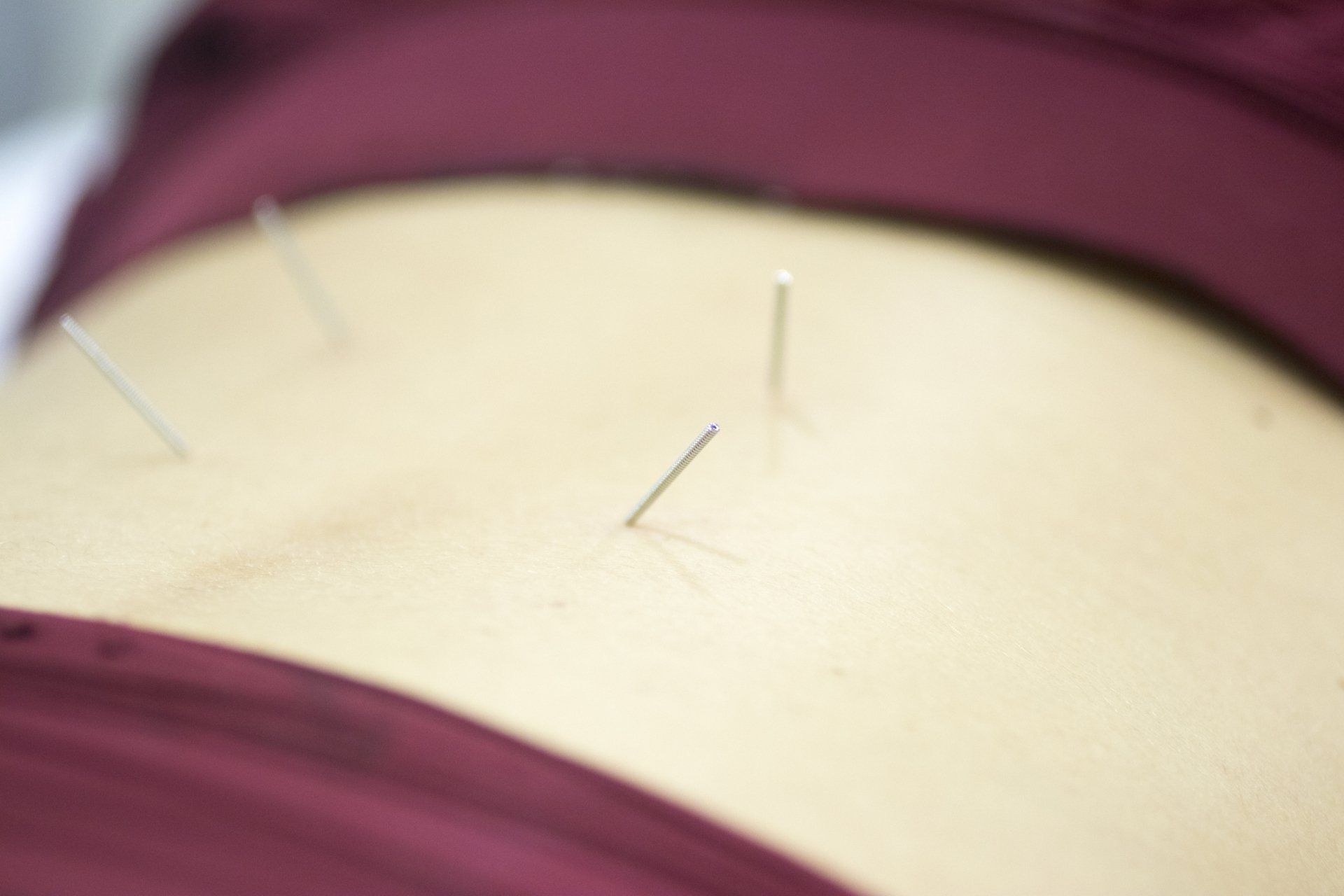 Dry Needling Treatment — Toukley, NSW — Physiophix