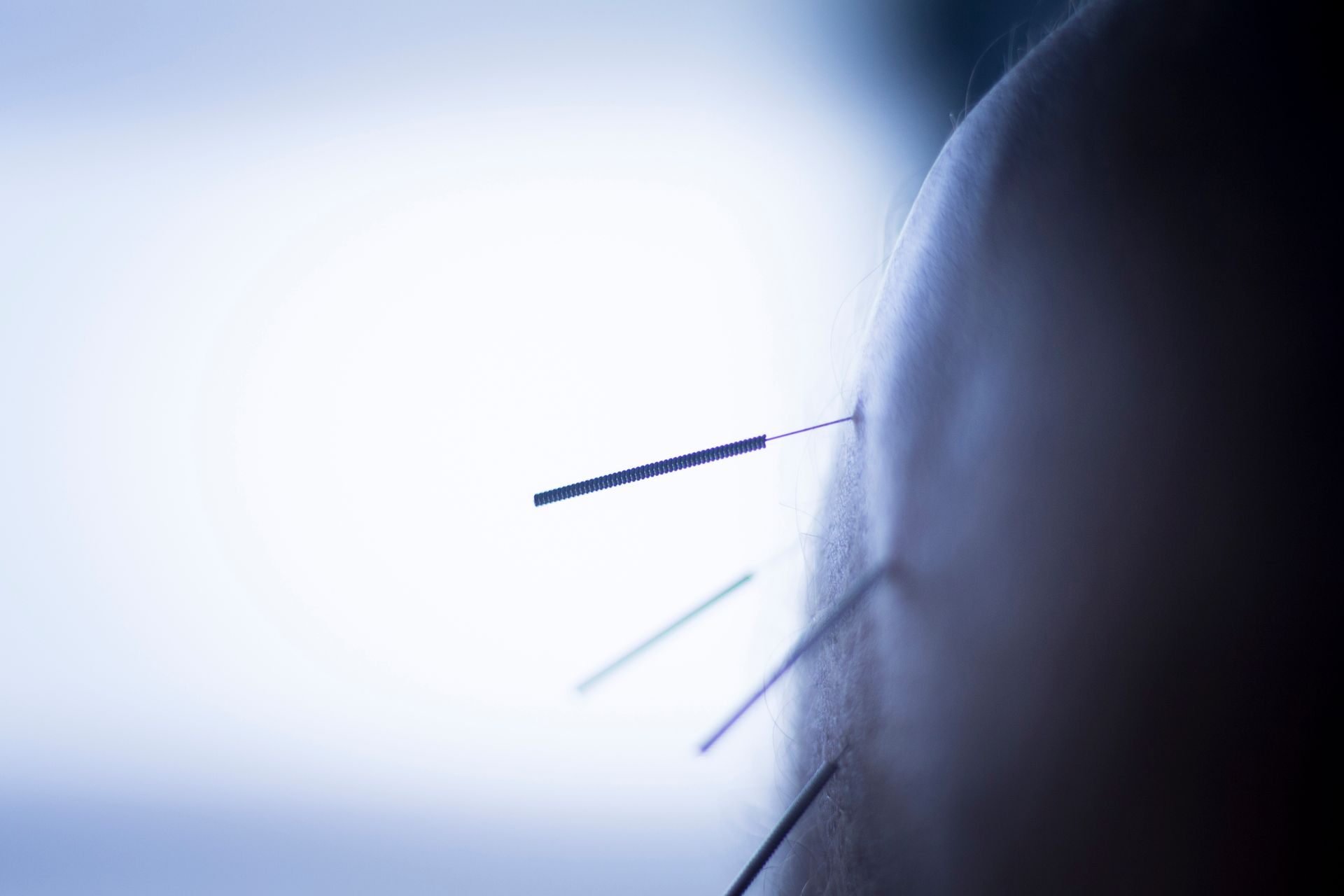 A person's shoulder with acupuncture needles inserted for treatment.