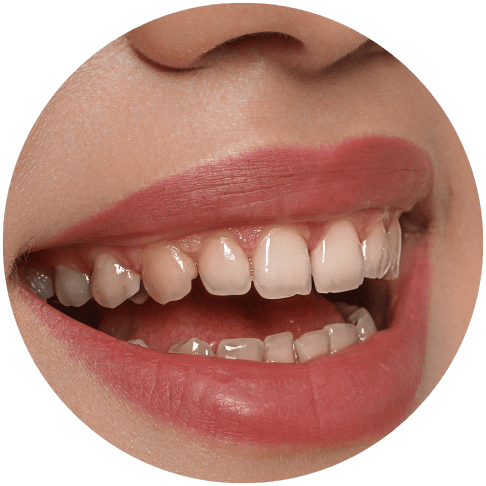 Close-up of a person smiling, showing teeth, upper teeth appear in aligner. Lips are painted with red lipstick.