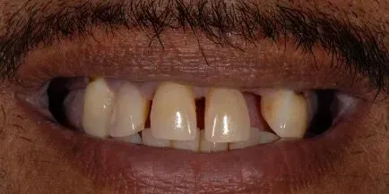 Close-up of a person's teeth. They are discolored, with noticeable gaps and one missing tooth.