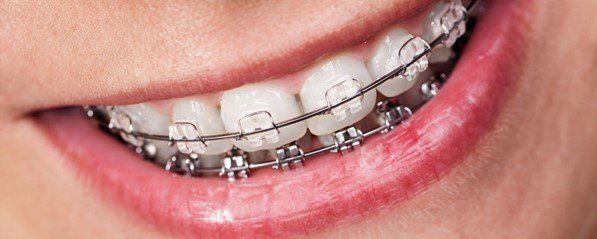 SEO Company is important to a Orthodontist
