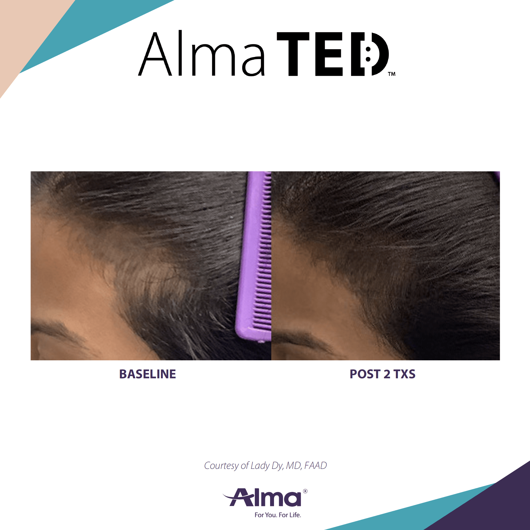 photos of female patient before and after Alma TED treatment