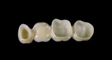 Ponte dentale, tre denti artificiali collegati, bianco crema su sfondo nero.