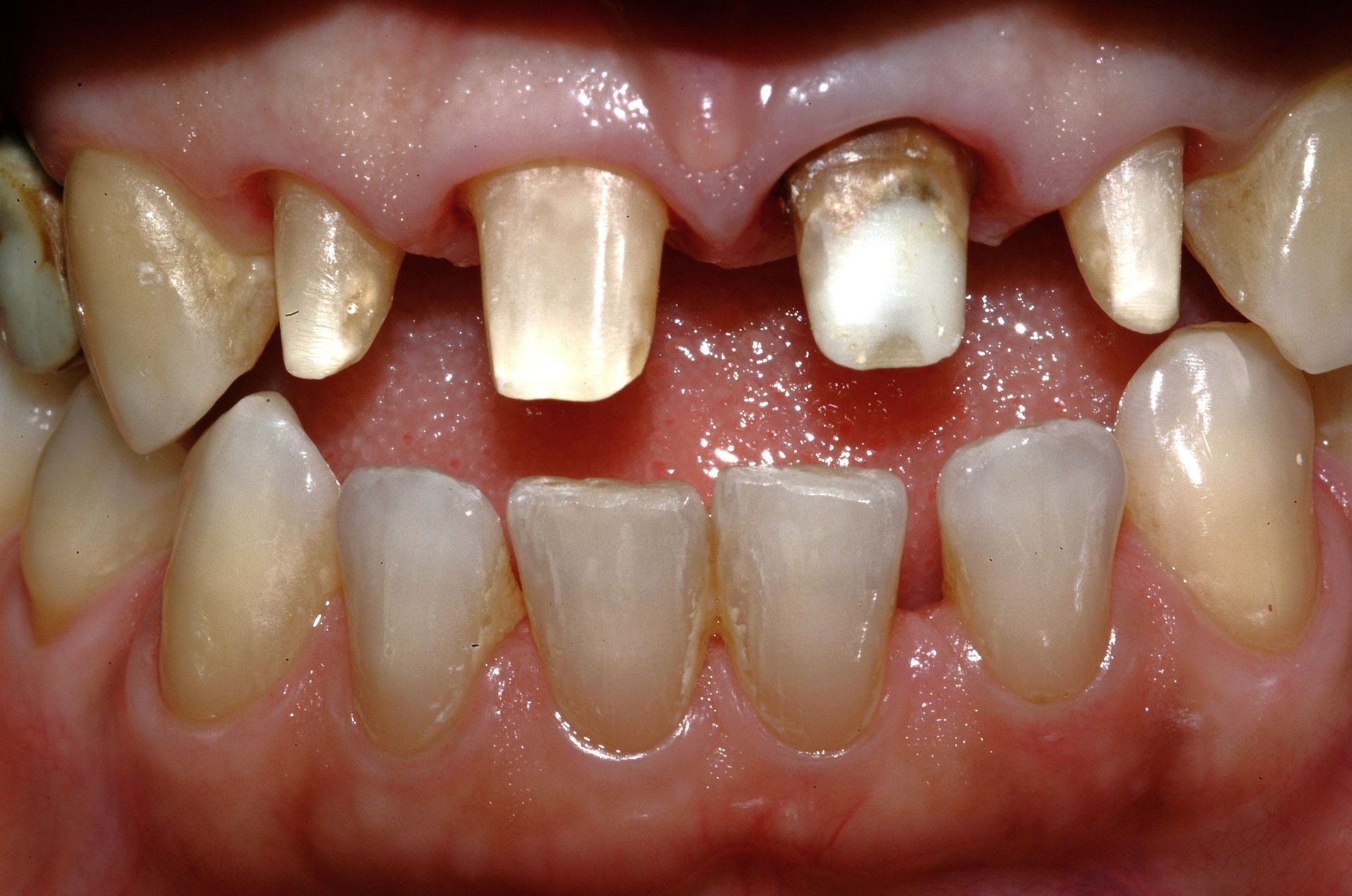 Primo piano dei denti di una persona che mostra carie e danni estesi. Diversi denti sono mancanti o rotti.