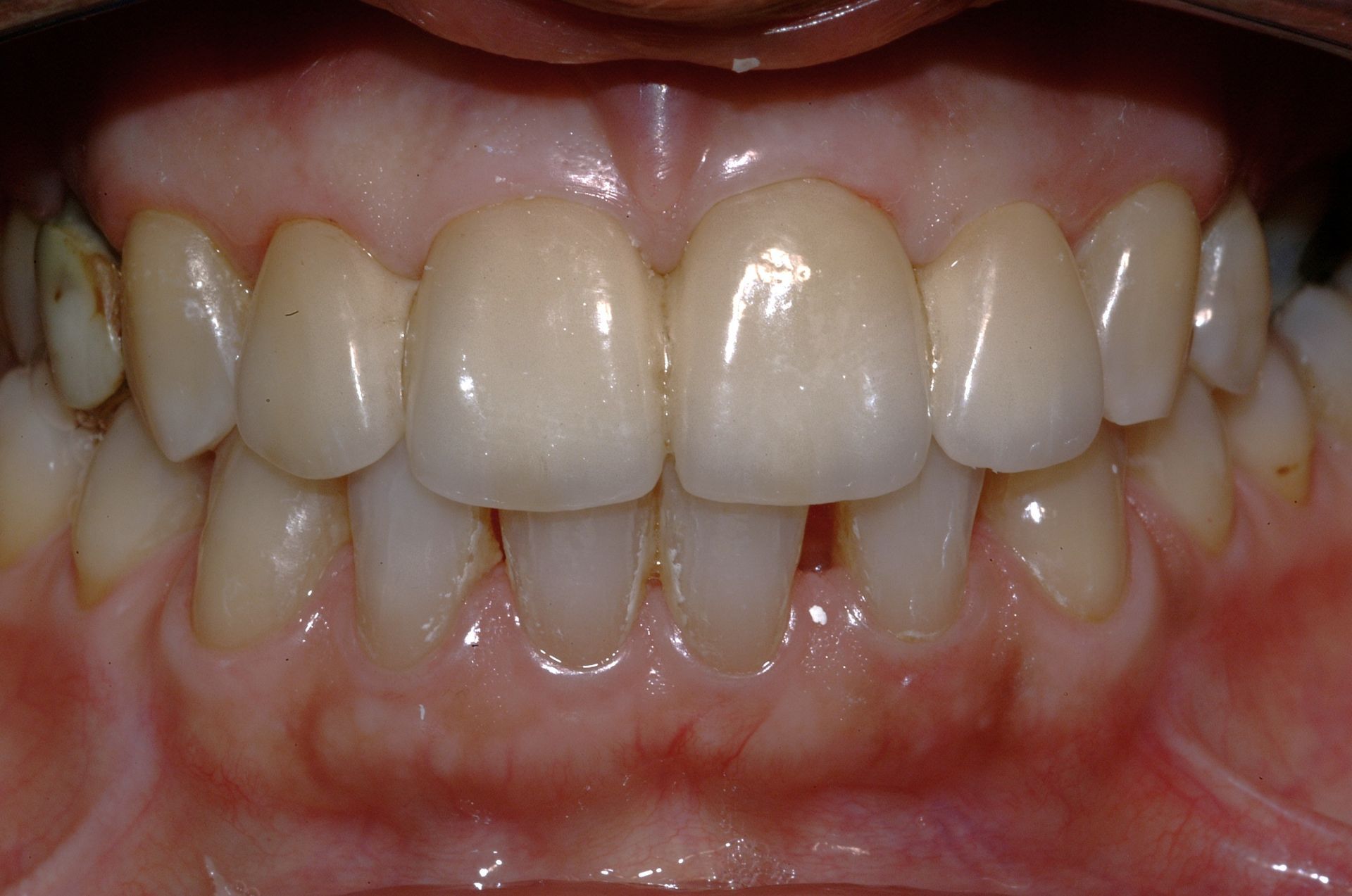 Primo piano di denti umani, che mostra un mix di denti naturali e probabilmente restaurati, con uno spazio leggermente visibile.