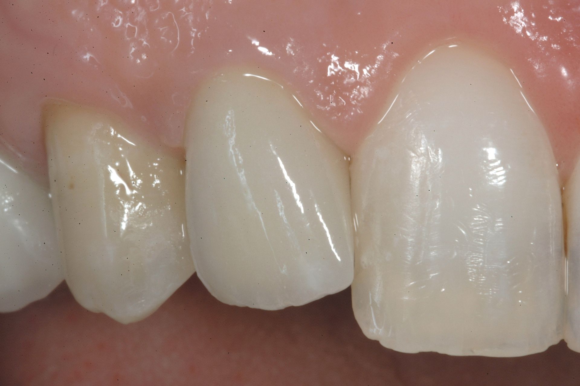 Primo piano dei denti; due sono capsulati, di colore beige chiaro, contro il bordo gengivale rosa.