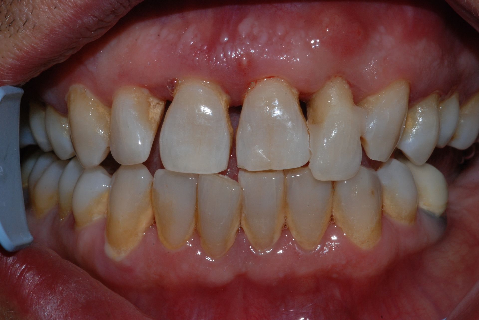 Primo piano dei denti con scolorimento e spazi vuoti; probabile visita odontoiatrica.