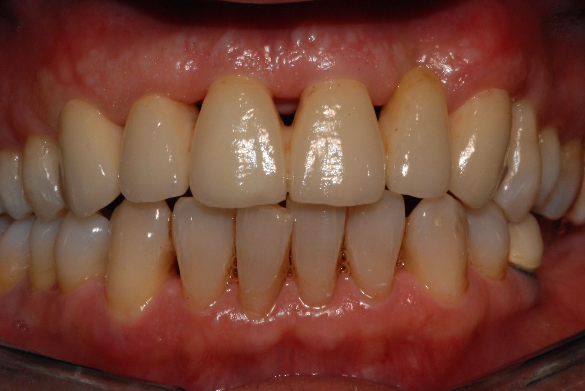 Primo piano dei denti. I denti anteriori sono bianchi e ben allineati, con una sfumatura giallastra sui denti inferiori. Le gengive appaiono sane.