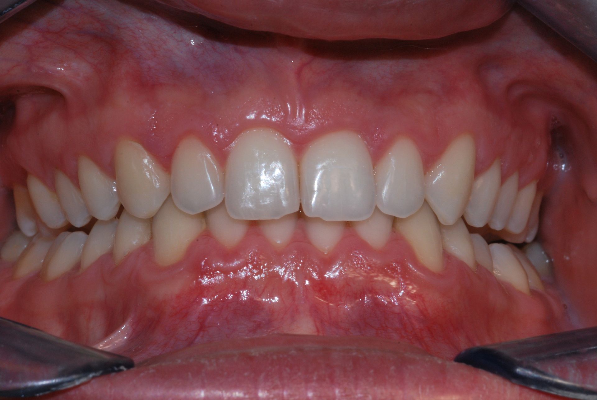 Primo piano dei denti di una persona, che mostra una dentatura completa, dritta e bianca in una bocca sana.