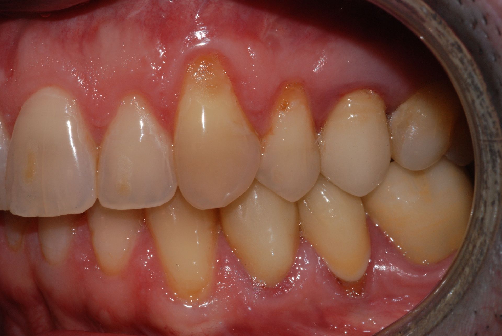 Primo piano dei denti superiori di una persona. Le gengive sono visibili e leggermente infiammate, con un leggero ingiallimento sui denti.
