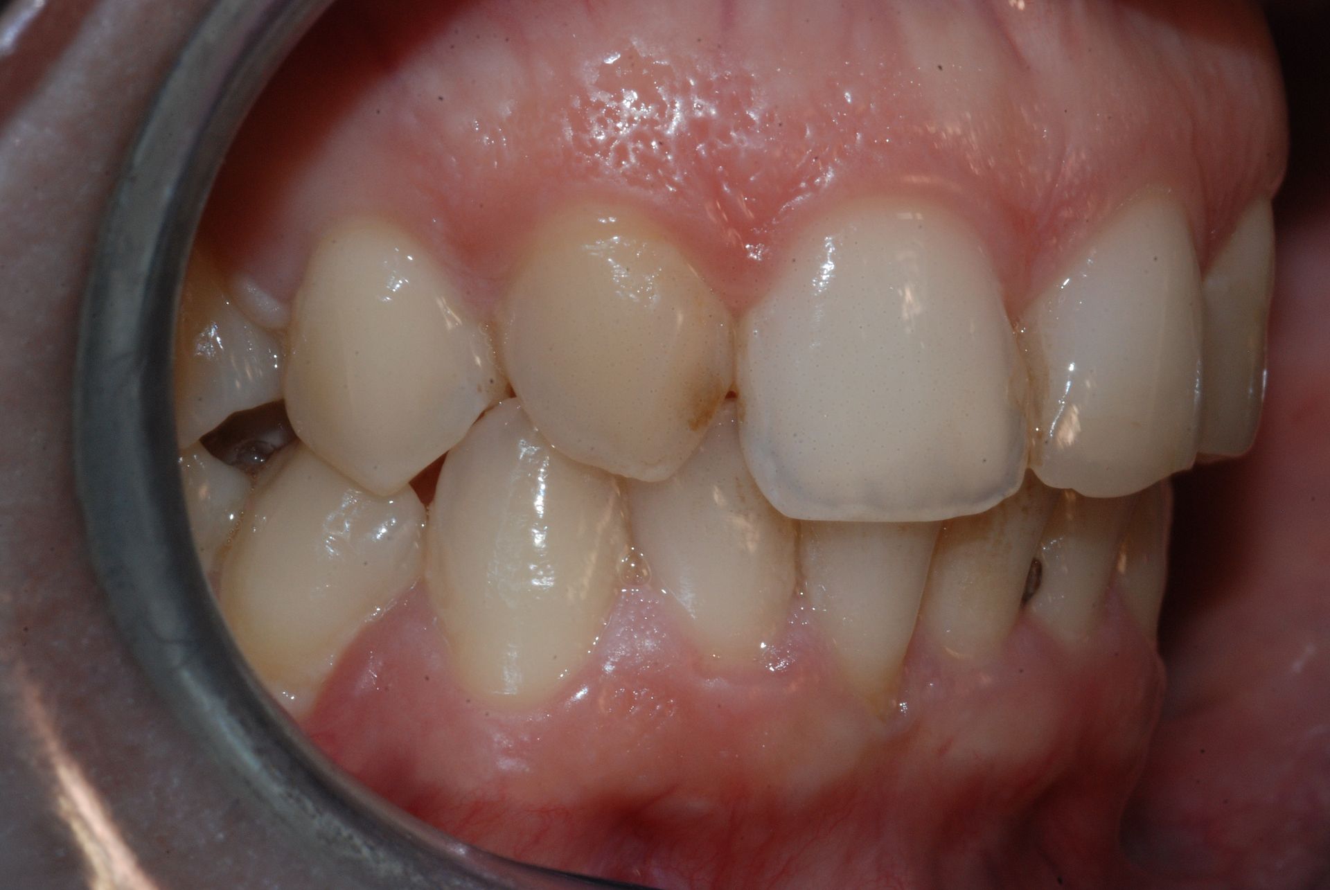 Primo piano dei denti di una persona, che mostra un leggero affollamento. Gengive rosa e denti biancastri sono visibili di profilo.