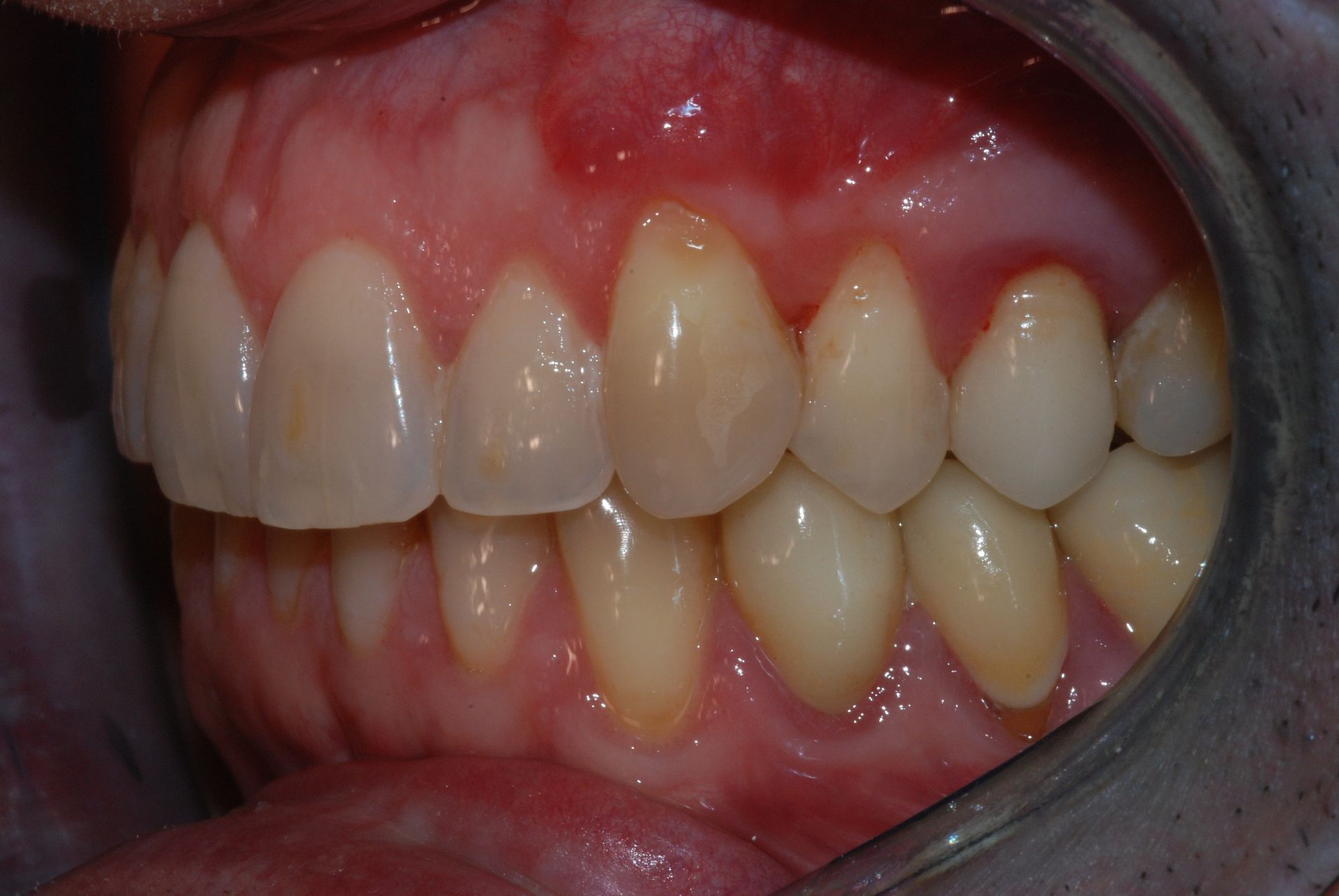 Vista laterale dei denti in bocca, che mostra gengive sane e denti leggermente ingialliti.