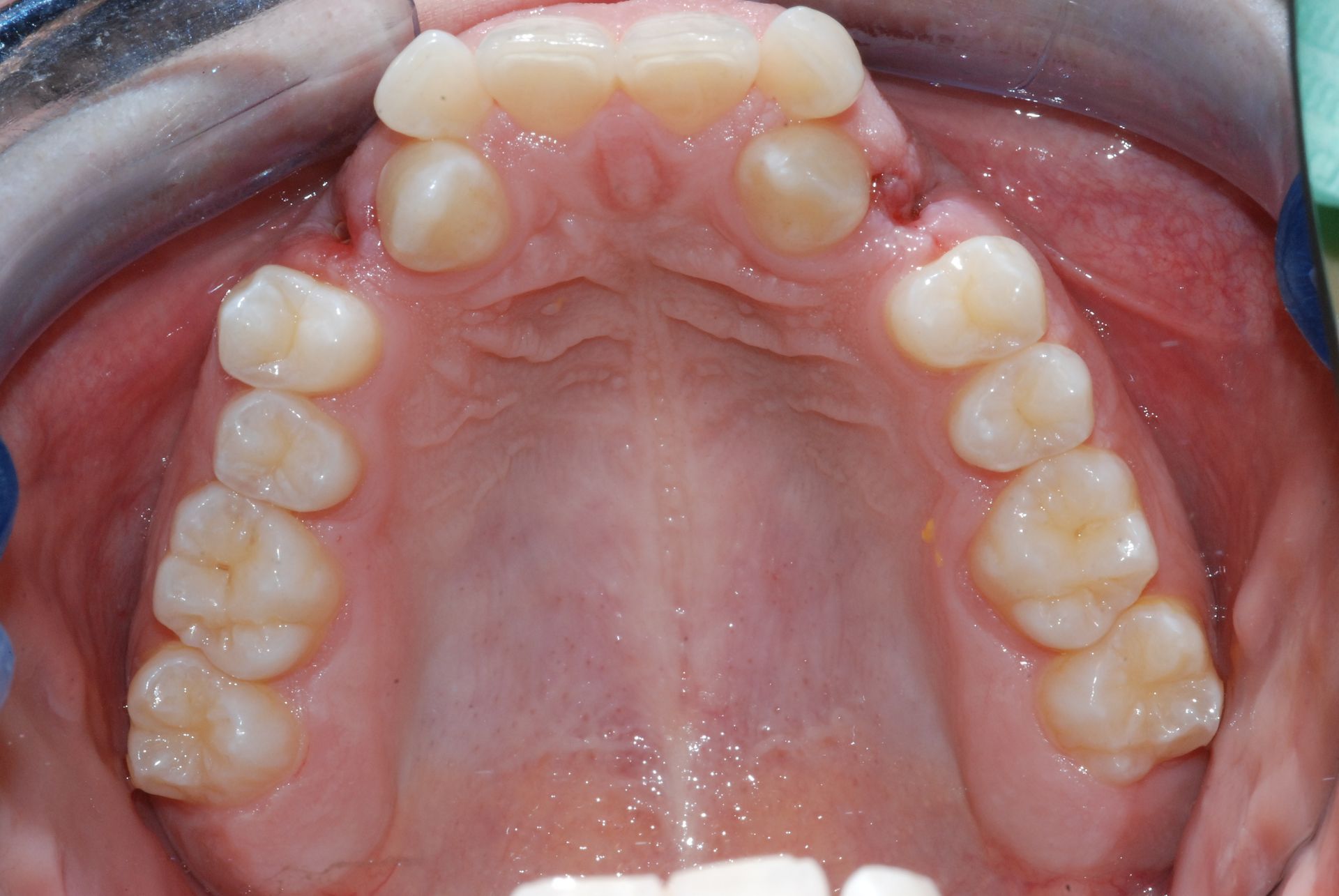 Vista superiore dei denti nella bocca di una persona, che mostra la fila superiore di denti. Sono visibili le gengive rosa e i denti bianchi.