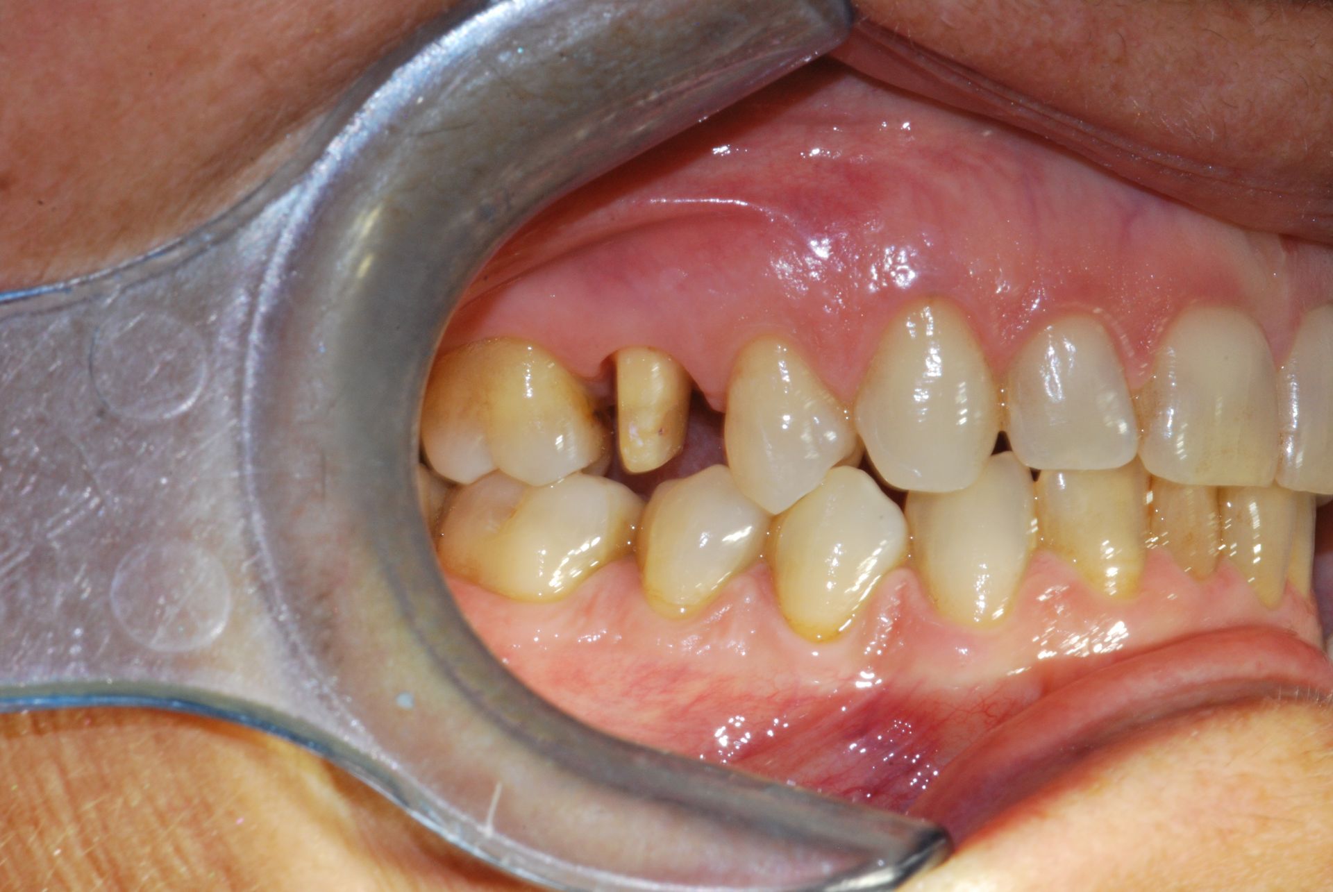 Bocca aperta con divaricatore dentale che mostra un dente mancante e denti ingialliti.