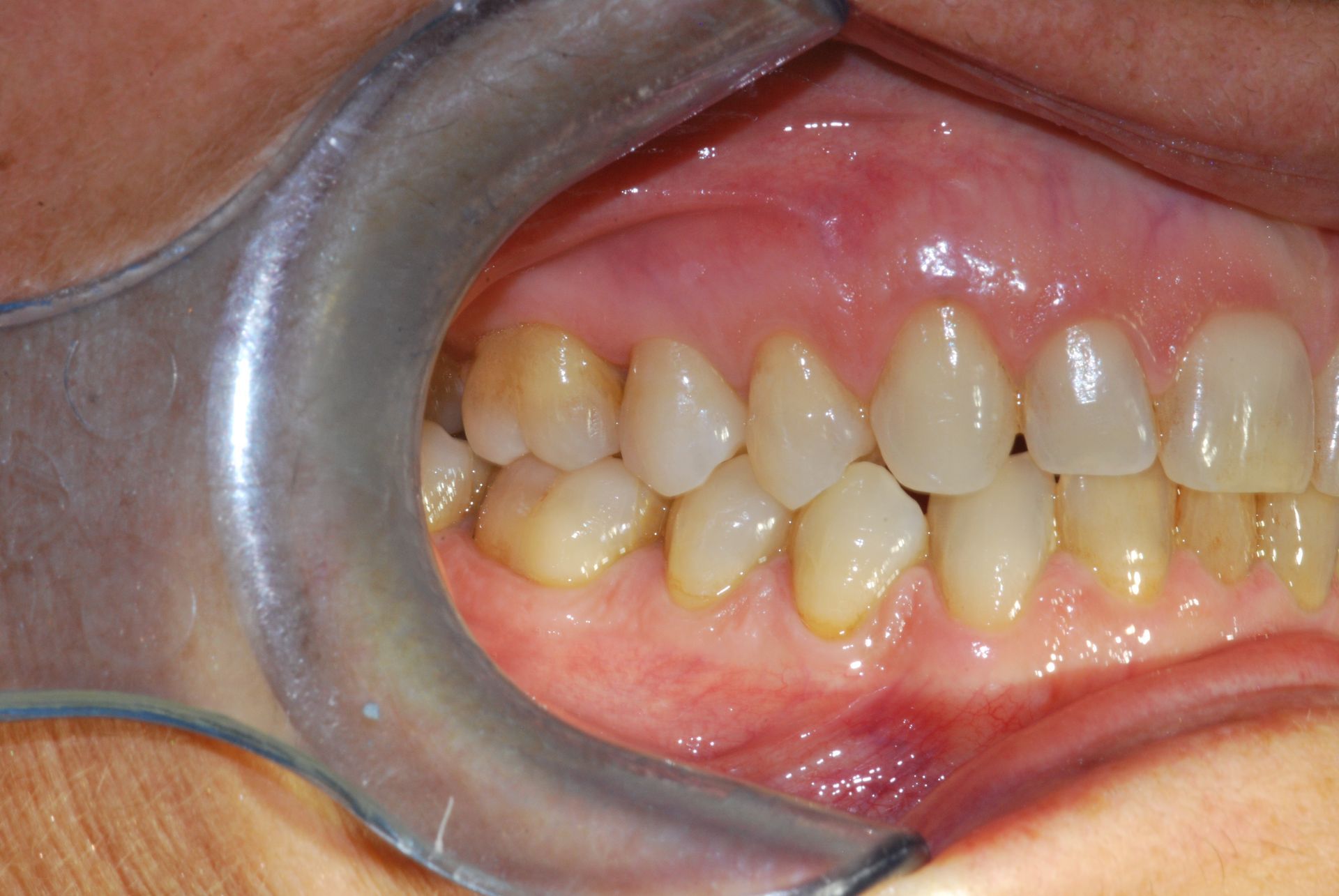 Denti e gengive nella bocca di una persona con un retrattore dentale in metallo.