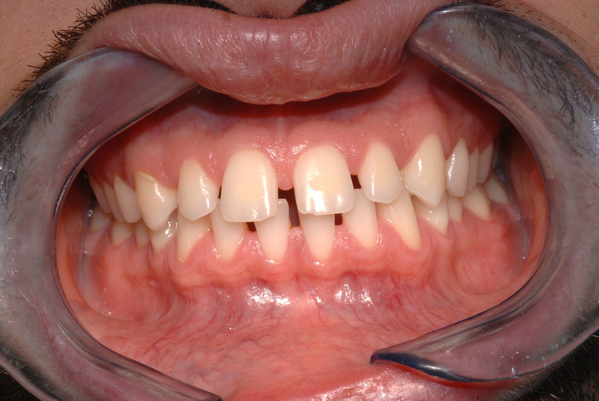 Bocca con diastema (spazio) tra i due denti anteriori, tenuti aperti da un retrattore dentale.