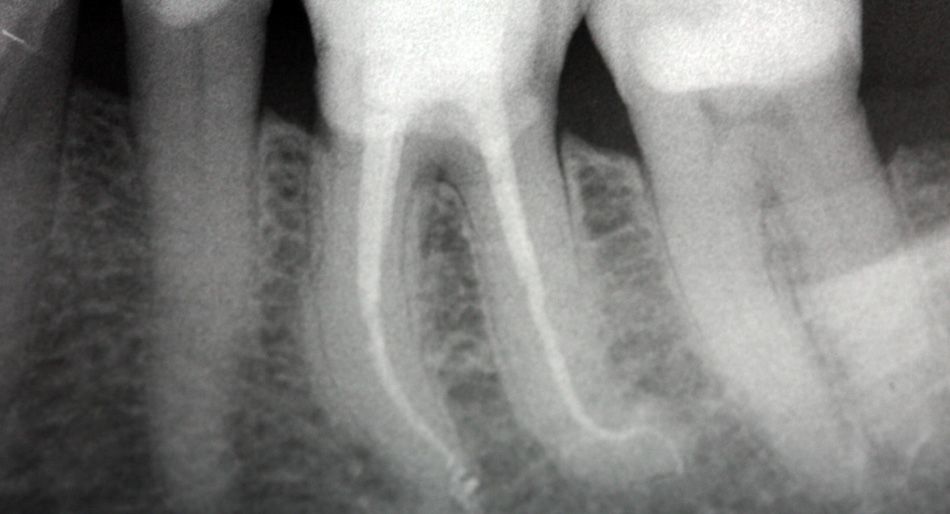 Radiografia dentale di un dente; il trattamento canalare è visibile con contorni netti, su uno sfondo scuro.