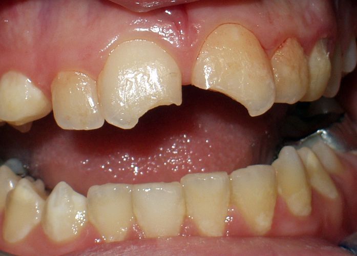 Vista ravvicinata dei denti, due denti anteriori scheggiati, che mostrano la cavità orale.