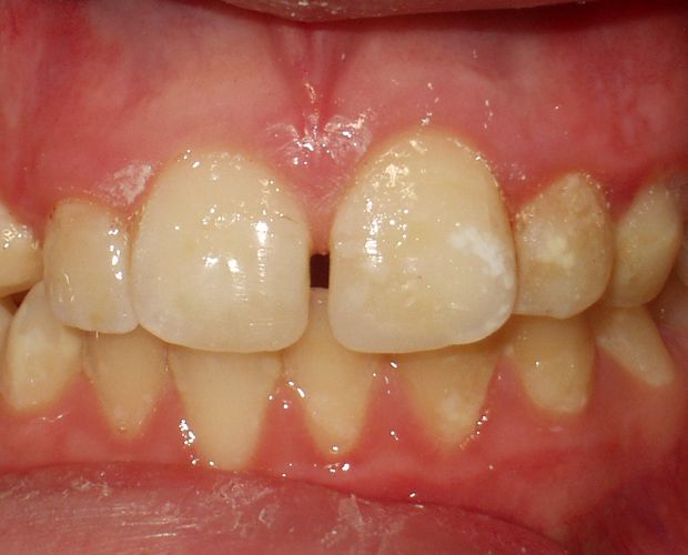 Primo piano dei denti anteriori che mostra uno spazio tra i due denti anteriori e una leggera decolorazione.