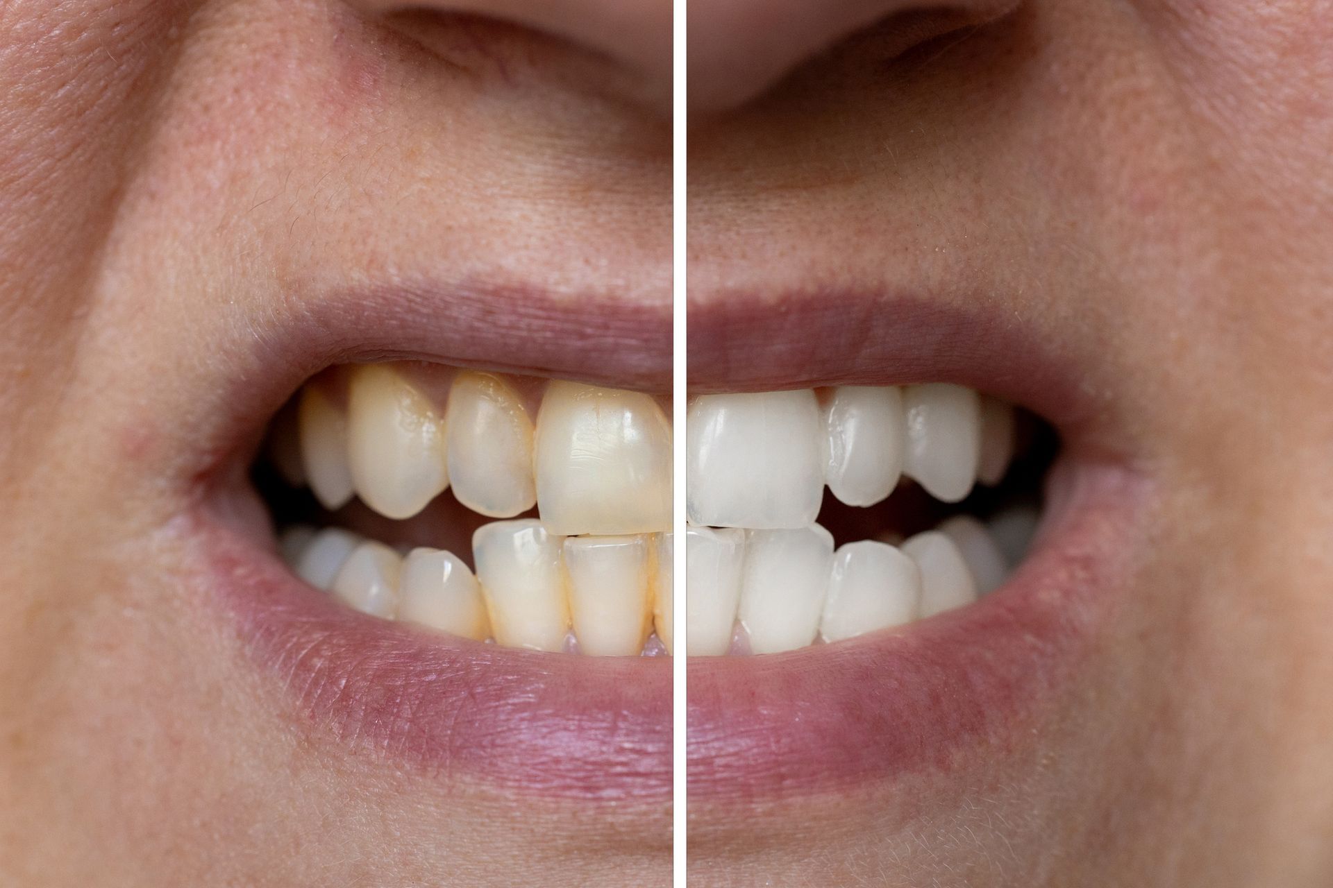 Confronto affiancato: denti gialli (sinistra) vs. denti sbiancati (destra) nella bocca di una persona.