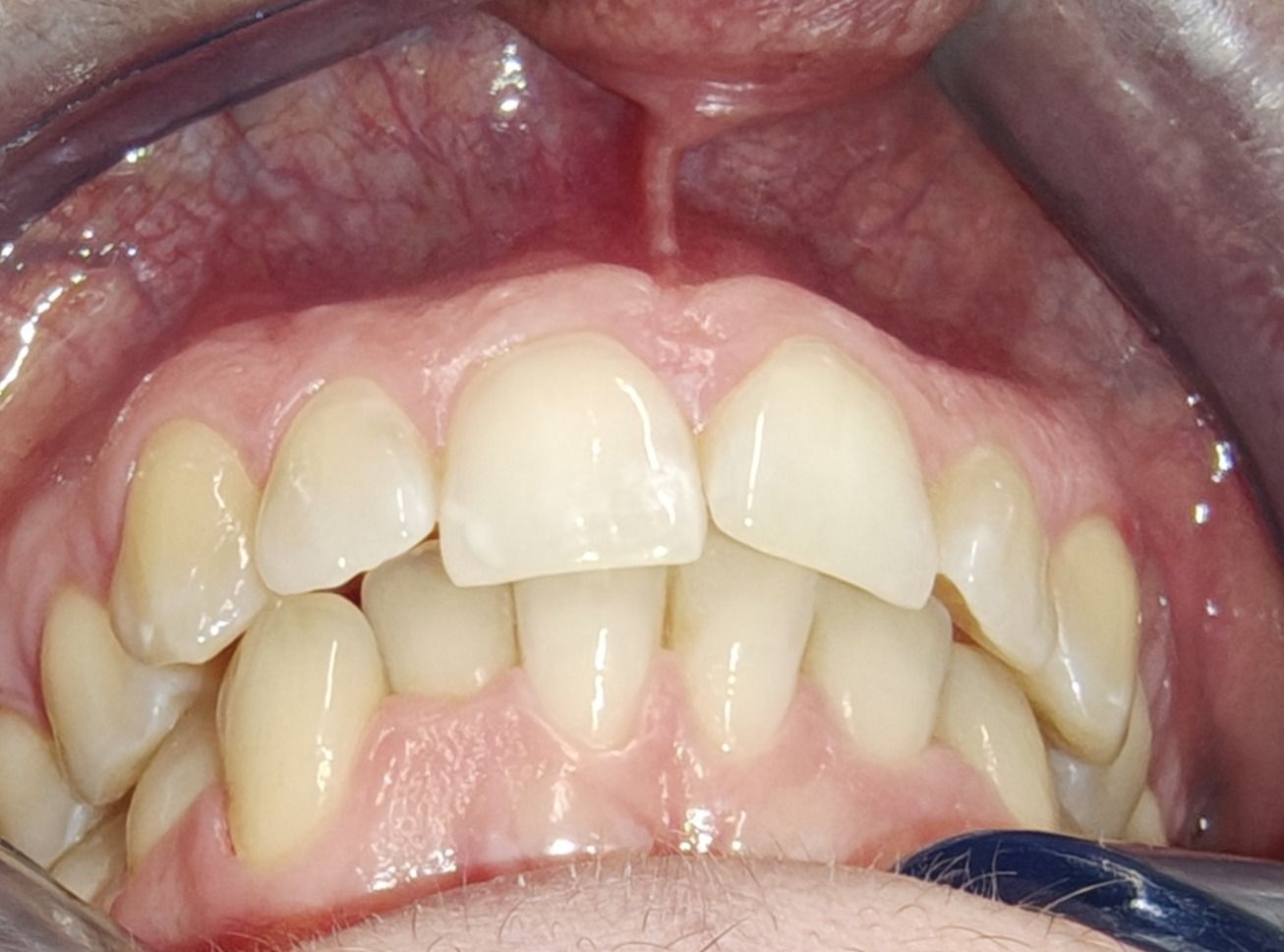 Primo piano dei denti superiori e delle gengive di una persona. I denti sono bianchi e leggermente disallineati. Le gengive sono rosa e dall'aspetto sano.
