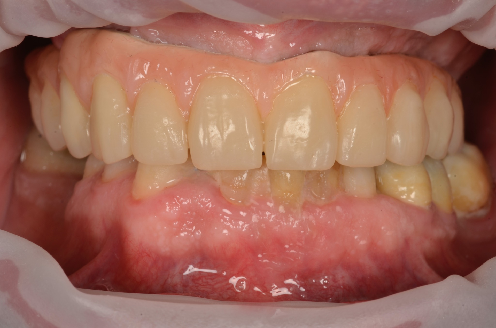 Primo piano della bocca di una persona, che mostra i denti superiori e inferiori. Le gengive sono rosa, i denti sono chiari.