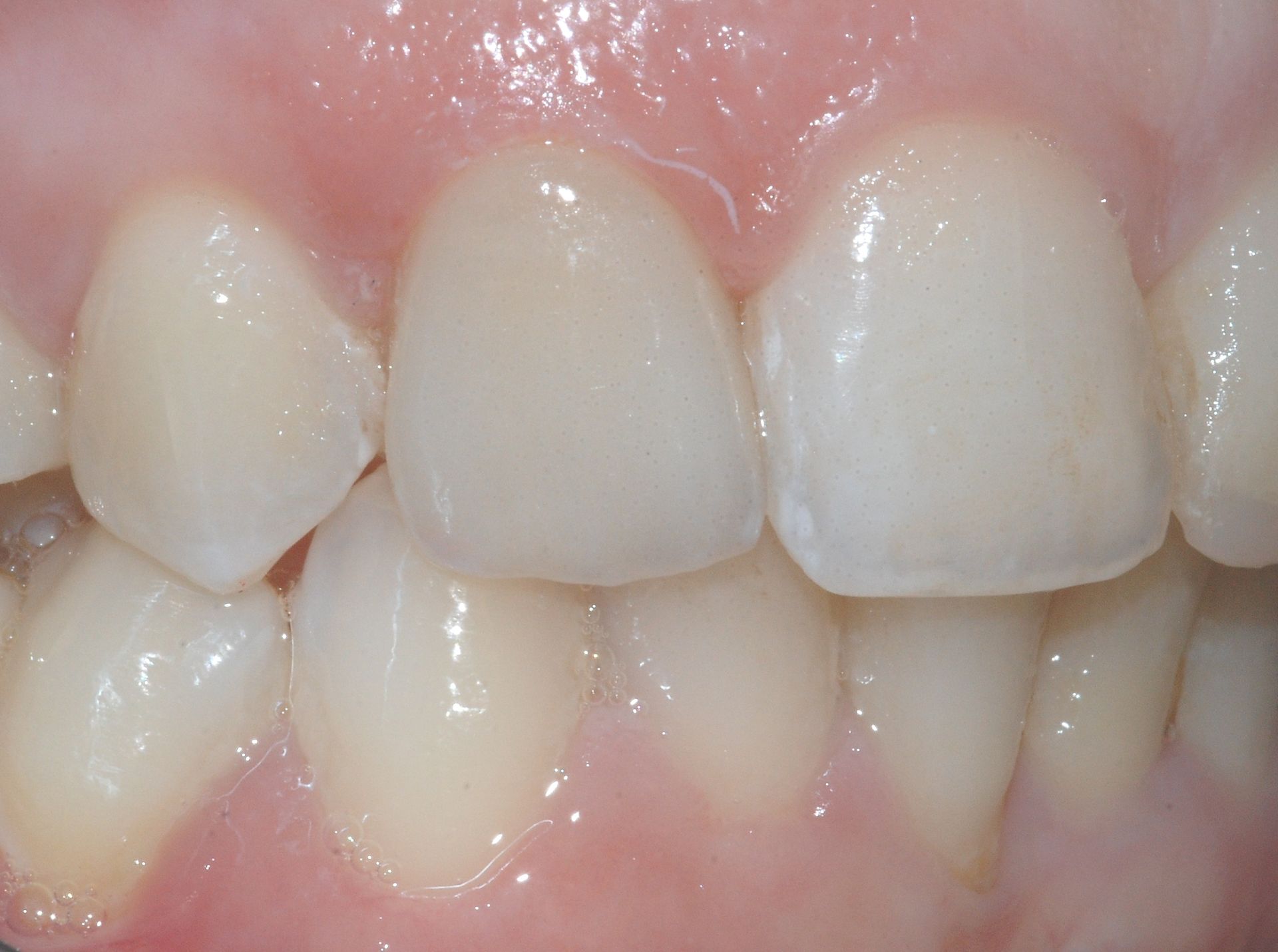 Primo piano dei denti umani; i denti anteriori sono bianchi e le gengive sono rosa.